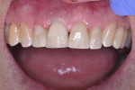 Fig 15. Completed restoration on the implant demonstrating a natural emergence profile with healthy gingiva and the absence of inflammation.