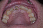 Fig 7. Occlusal view of fractured central incisor with past history of root canal therapy.