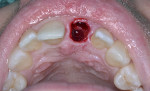 Fig 17. Atraumatic removal of affected tooth.