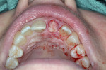 Fig 20. PRF membrane placed over immediate implant and tucked under buccal and lingual gingival margins.