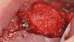 Fig 9. 5-month postoperative clinical appearance left maxillae.