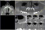 Fig 11. 1.5-year post-treatment CT scan and serial view, left sinus area, case 1.