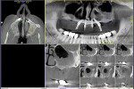Fig 10. 1.5-year post-treatment CT scan and serial view, right sinus area, case 1.