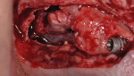 Fig 13. Pre-corrected defect, maxillary right, case 2.
