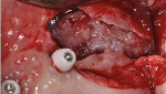 Fig 8. Pre-corrected defect left maxillae, case 1.