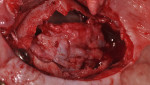 Fig 14. Pre-corrected defect, maxillary left, case 2.