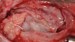Fig 4. Right sinus large crestal defect, case 1.