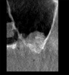 Fig 21. 2-year post-correction CT scan serial view, right sinus, case 2.