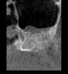 Fig 22. 2-year post-correction CT scan serial view, left sinus, case 2.