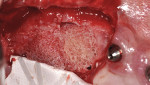 Fig 26. Stem cell cube graft, right maxillary sinus defect, case 3.