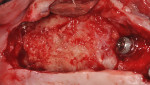 Fig 19. 5-month membrane removal and re-entry procedure, right sinus region, case 2.