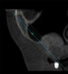 Fig 30. 1-year postoperative CT scan serial view, right sinus region, case 3.