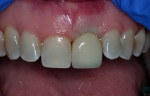 Fig 24. Final restoration of the implant demonstrating healthy gingival tissue.