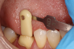 Fig 2. Because the color of underlying tooth structure will influence the choice of translucent zirconia material selected, a preoperative shade was taken.