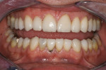 Figure 1  Dark stains and chipping were evident in restorations on teeth Nos. 22 through 27.