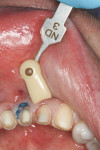 Figure 3  Shade selection was performed, and a small cord can be seen on tooth No. 25.