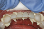 Figure 7  RelyX™ Veneer Cement was used to seat the crowns.