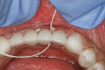 Figure 8  Floss was used to remove excess interproximal cement.