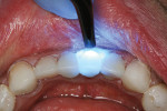 Figure 9  Excess cement was tack-cured, followed by a full cure of the restorations.