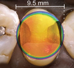 Fig 2 through Fig 4. Overlay of a beam profile on a MOD cavity preparation for a premolar and light diameters sized to demonstrate clinical conditions (hot spots: red, orange, yellow; cold spots: blue, violet). Fig 2: Light A premolar MOD preparation – The irradiance values over the proximal boxes are inadequate and the light tip does not cover the entire occlusal surface. Fig 3: Light B premolar MOD preparation – The irradiance values over the proximal boxes