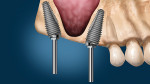 Parallelism of the prosthetic platform on the convergent Co-Axis implants placed to
avoid the sinus.