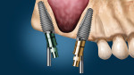 Co-Axis implants placed to avoid the
sinus with implant long axis convergent.