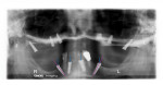Panoramic radiograph showing Co-Axis implants placed in the distal sites bilaterally. The purple
line indicates the long axis of the Co-Axis implants and the blue line indicates the prosthetic axis of the implants.