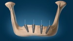 Illustration of the mandible with placement
of Co-Axis implants in the distal positions to
avoid the mental foramen and spread the support base of the implants. Note that although the implants are angled, the prosthetic platforms are parallel.