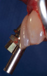 Clinical example of a Co-Axis implant
placed in the anterior maxilla showing the
bulk of the fixture mount facial to the facial surface of the adjacent tooth (implant long axis) and the prosthetic emergence shown by the long pin emerging at the incisal edge.