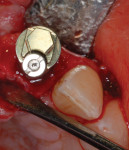 Clinical example of the occlusal view of the Co-Axis implant shown in Figure 11 placed at a maxillary central incisor position showing screw
access in relation to the bulk of the fixture mount for a straight fixture.