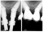 Convergent Co-Axis implants placed to
avoid an enlarged maxillary sinus. (Figure courtesy of Dr. Kent Yuen.)