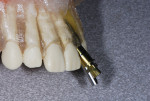 Illustration on a model showing a Co-Axis implant placed according to the bone
available in the anterior maxilla. The placement
head illustrates the long axis of the implant in
relation to the long pin in the screw access hole.