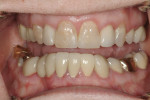 Figure 1  The patient was unhappy with the overall appearance of her teeth, particularly teeth Nos. 8 and 9.
