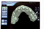 Figure 4  Screenshot of the digital scan of the upper arch.