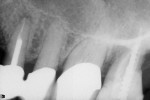 Figure 3  Preoperative and postoperative x-rays of tooth No. 4 diagnosed with classic pulpitis using anesthetic exclusion.