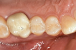 Figure 1  Preoperative view of the patient’s posterior tooth as it presented with caries.