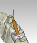 Fig 7. Restorations with angulated screw channels of up to 25 degrees can help to overcome issues of access.