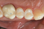 Figure 11  An immediate occlusal postoperative view of the patient’s completed restoration.