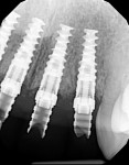 Four 3.5 mm NobelActive implants (Nobel Biocare) placed via fully guided surgical protocol. Immediate provisional restorations were delivered.