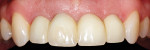 Screw-retained provisional crowns delivered
in the mouth. Note the facial screw access hole on tooth No. 8.