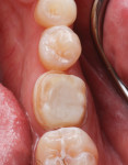 The tooth is prepped with surpragingival margins.