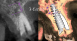 Fig 1. Example, sagittal view of anterior ridge showing apical implant engagement in host bone for primary stability for immediate implant placement.