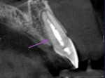 Fig 3. Cross-sectional view of tooth No. 9 showing fracture.
