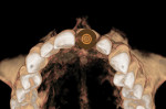 Fig 11. No. 9 implant position planning with 2 mm surrounding zone marked, occlusal view.