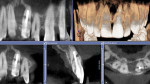 Fig 9. CBCT revealing failing root canal and associated lesion.