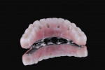 Fig 10. Metal bar was bonded into zirconia shell with dual-polymerizing composite resin.