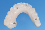 Fig 12. Approved PMMA provisional prosthesis.