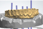 Fig 7. Approved PMMA provisional was cut-back to allow space for esthetic porcelain, as seen in this graphic representation of CAD/CAM file.