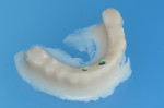 Fig 5. A screw-retained duplicate of the hybrid prosthesis was made of bisacrylic.
