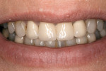 Figure 1  Preoperative view of the smile prior to extraction of tooth No. 8.